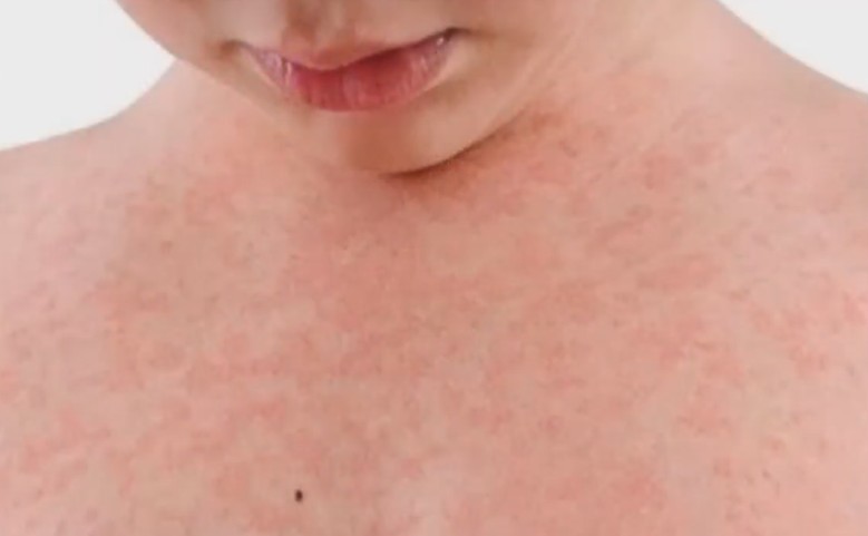 Aumentan casos de sarampión en Canadá